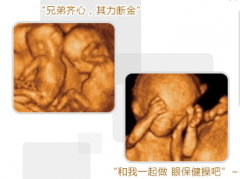 怀孕双胞胎几个月做四维彩超