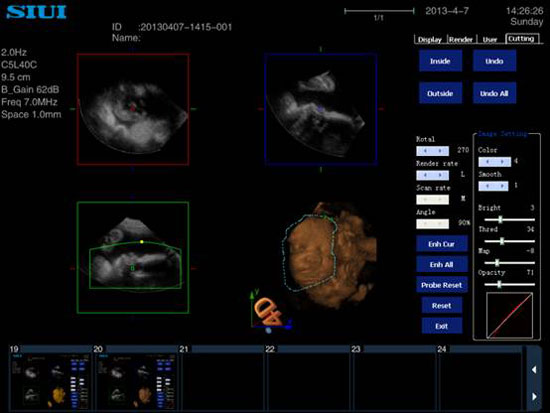 二维超声和三维超声有什么区别