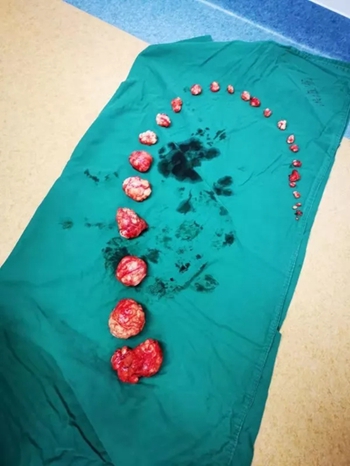 泉州福兴妇产医院成功为一患者剔除27个