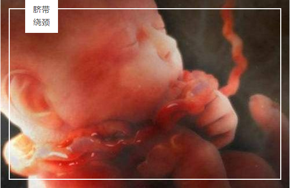 险！胎儿脐带绕颈5周，福兴妇产迅速“解套