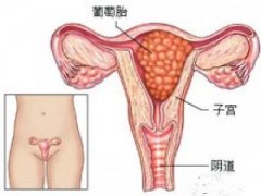 怀孕出血见红怎么办