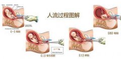 哺乳期可以做人流吗