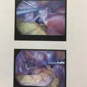 福兴妇产成功实施一例腹腔镜下巨大多发
