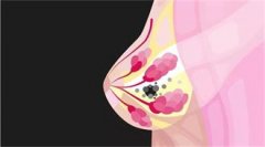 【邀】7月3日乳腺健康沙龙|福医二院甲